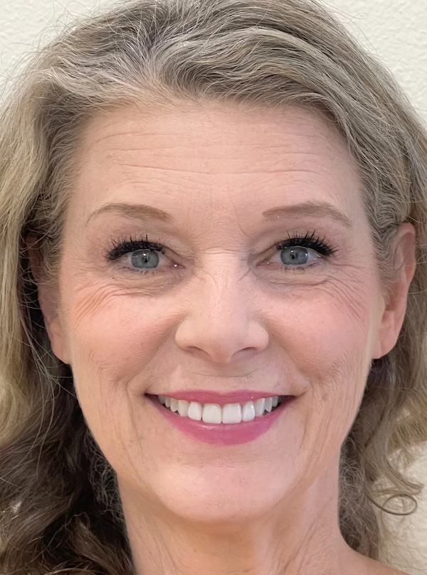 Betty Ann Full Face After