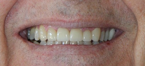 Veneers after 2