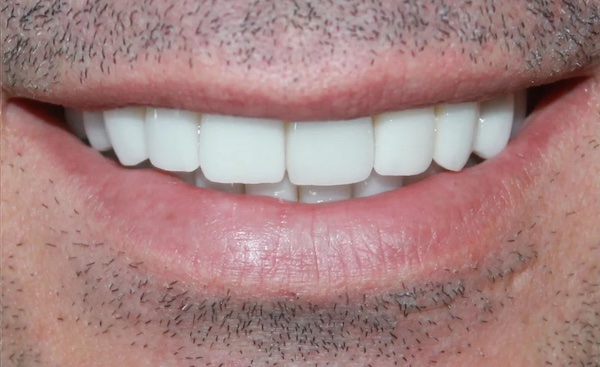 Veneers after