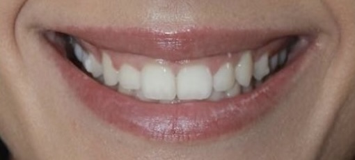 Veneers 1