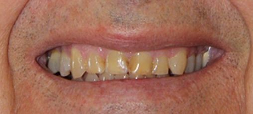 Veneers before 2