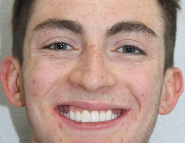 Anderson Full Face After