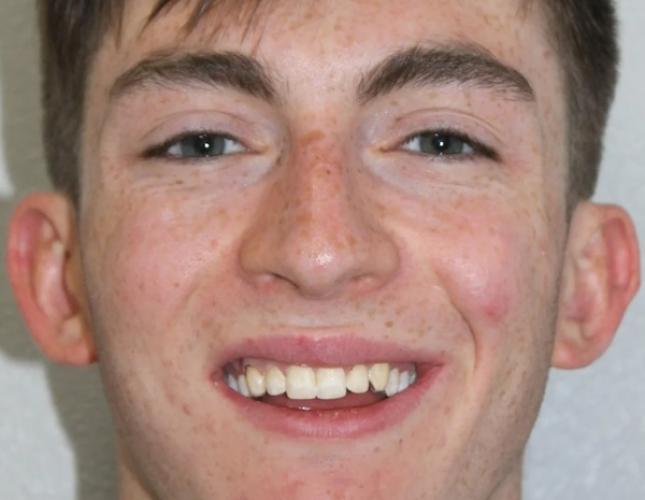 Anderson Full Face Before