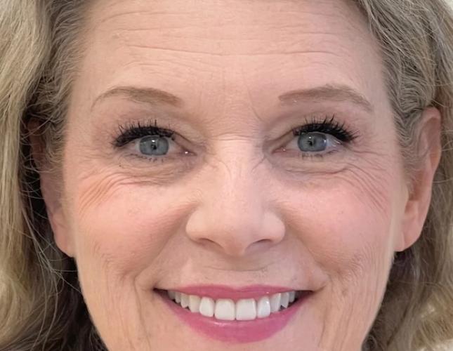 Betty Ann Full Face After