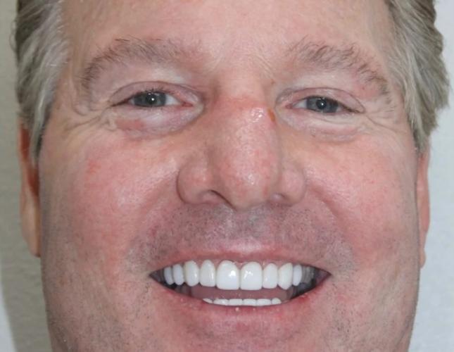 Brett Full Face After