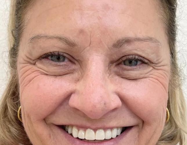 Diane Full Face After