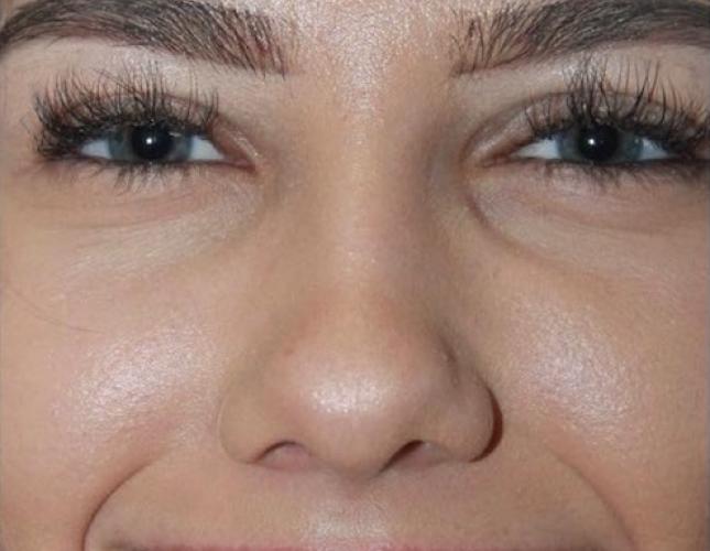 Gigi Full Face Before