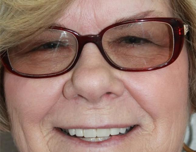 Helen Full Face After