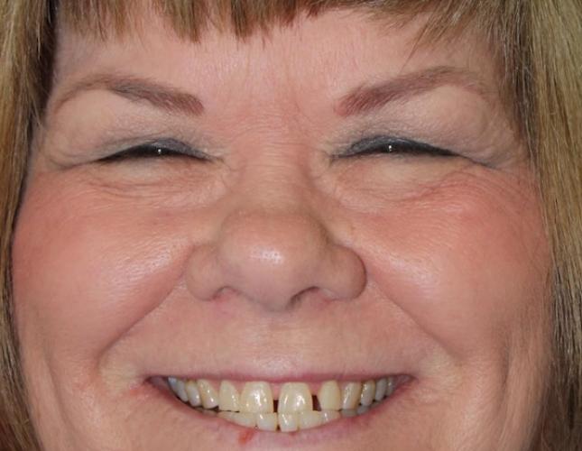 Helen Full Face Before