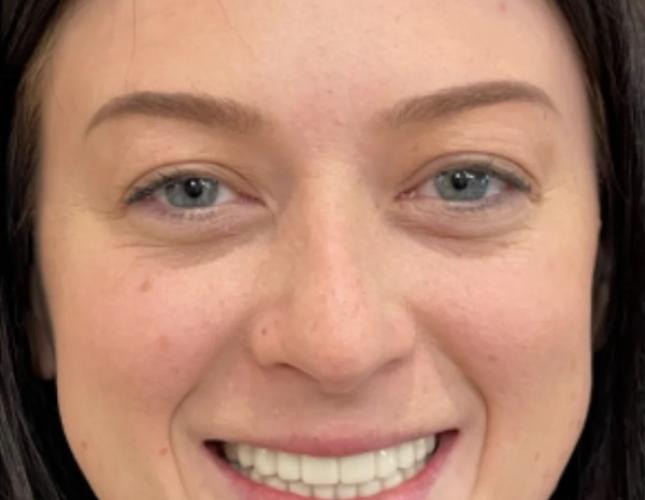 Kylie Full Face After