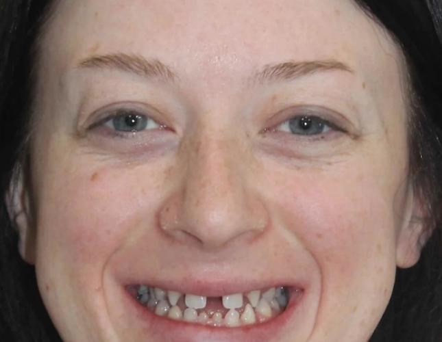 Kylie Full Face Before