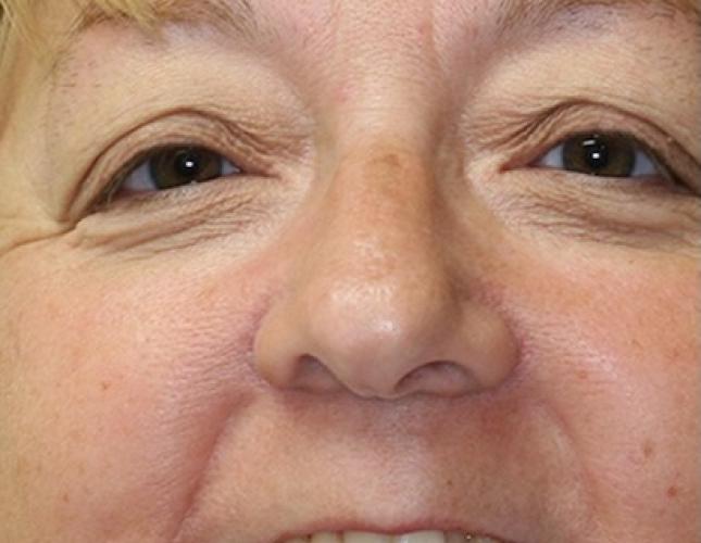 Marianne Full Face Before