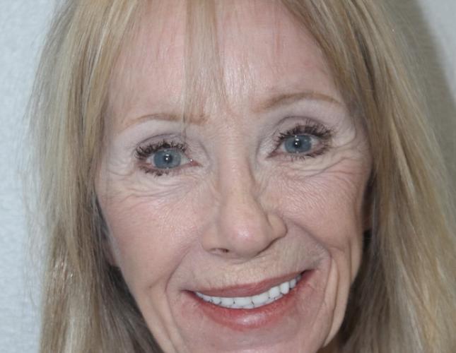 Karen Full Face After