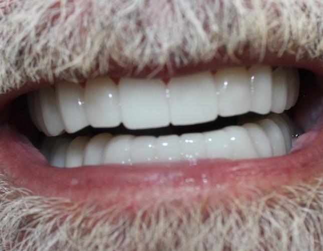 Snap on Smile After