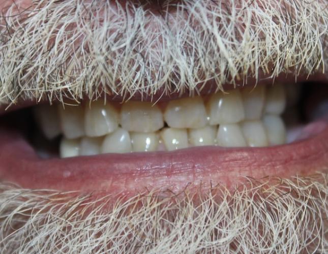 Snap on Smile Before